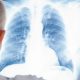 Atenţionarea pneumologilor: un bărbat din 15 riscă să fie diagnosticat cu cancer pulmonar, până la 75 de ani