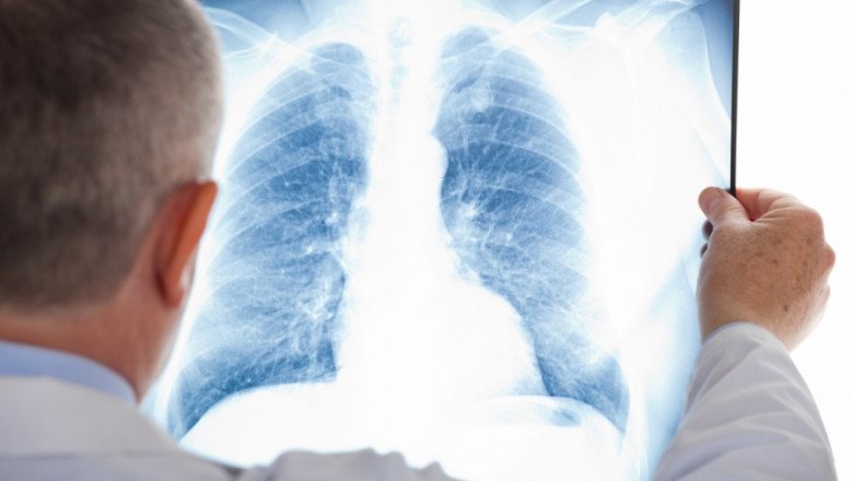 Atenţionarea pneumologilor: un bărbat din 15 riscă să fie diagnosticat cu cancer pulmonar, până la 75 de ani
