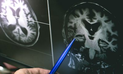 Ziua Internațională Alzheimer: Peste 7.900 de cazuri noi în România, înregistrate doar anul trecut/ Semnele și simptomele timpurii ale bolii