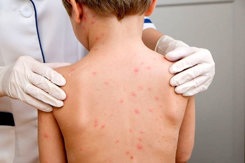Rafila, despre epidemia de rujeolă: "Este o consecinţă a acumulării unei cohorte de copii nevaccinaţi"