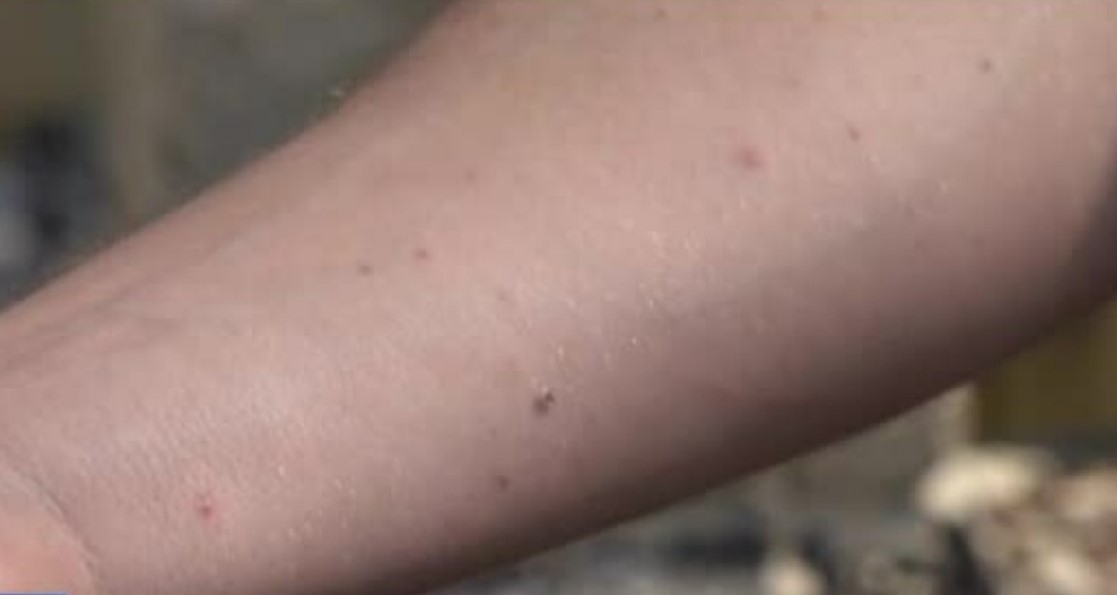 Insecta tigrul de platan provoacă mâncărimi severe în Parcul Poligon Florești