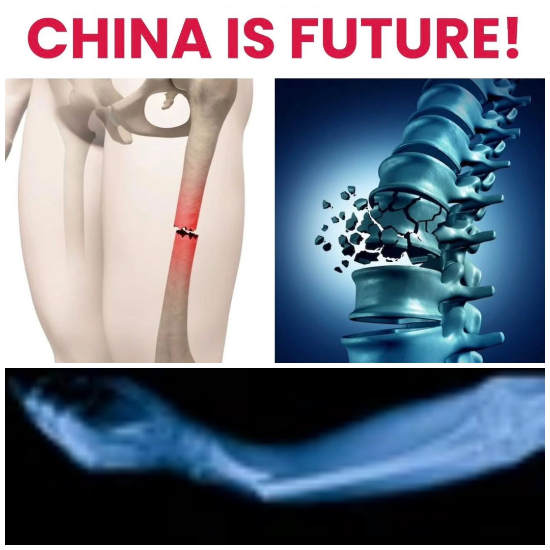 Lipici medical Bone-02 din China care lipește oasele în câteva minute fără șuruburi și plăci